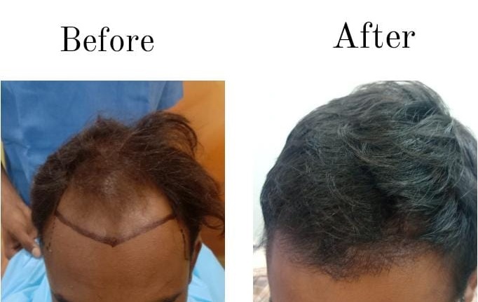 hair transplant RESULTS in Jaipur at Mediskin by Dr Venkatesh