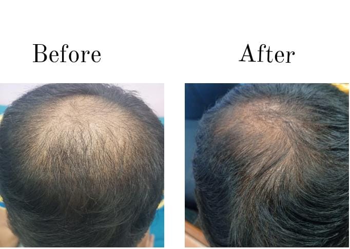 The Ultimate Guide to Hair Loss Treatment – Dr venkatesh purohit, Dermatologist