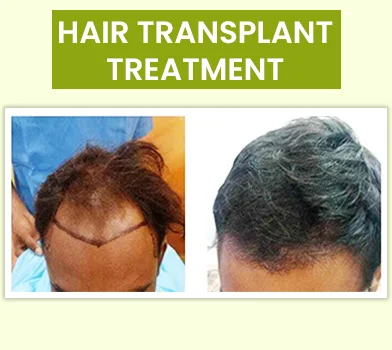 hair transplant treatment