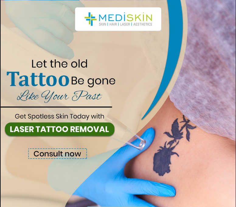 laser tattoo removal treatment jaipur