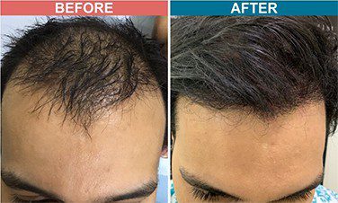 Why PRP is important after Hair Transplant? – Dr. Venkatesh Purohit (Dermatologist Jaipur)