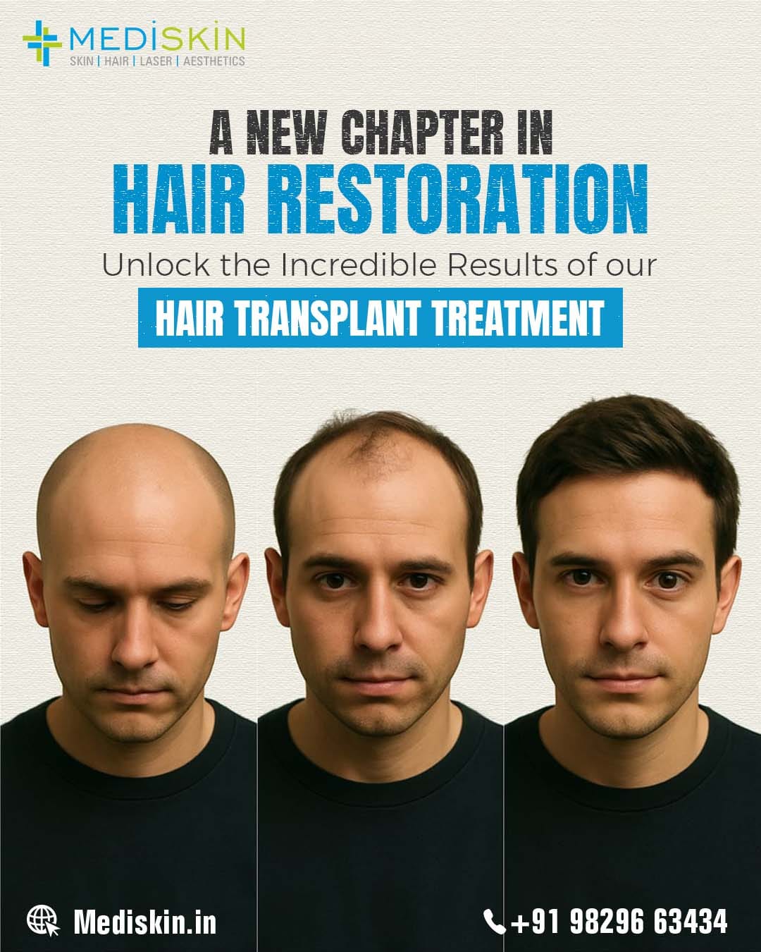 A New Chapter in Hair Restoration: Unlock the Incredible Results of Our Hair Transplant Treatment