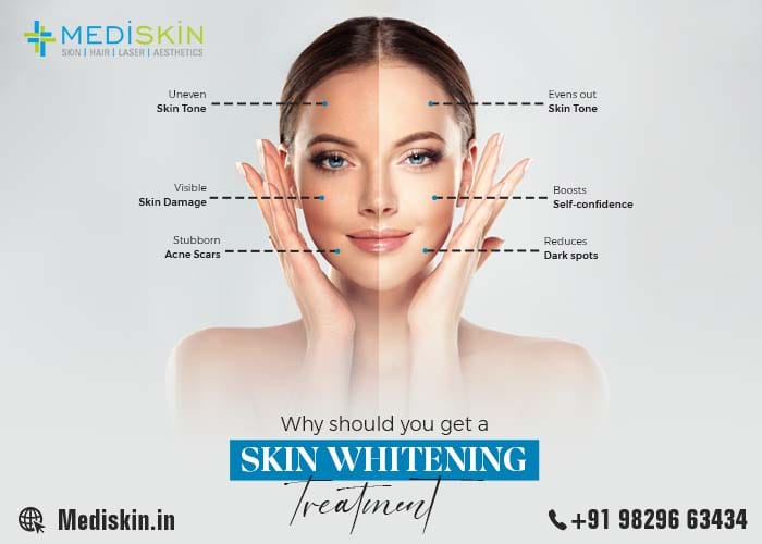 Why Should You Get a Skin Whitening Treatment?