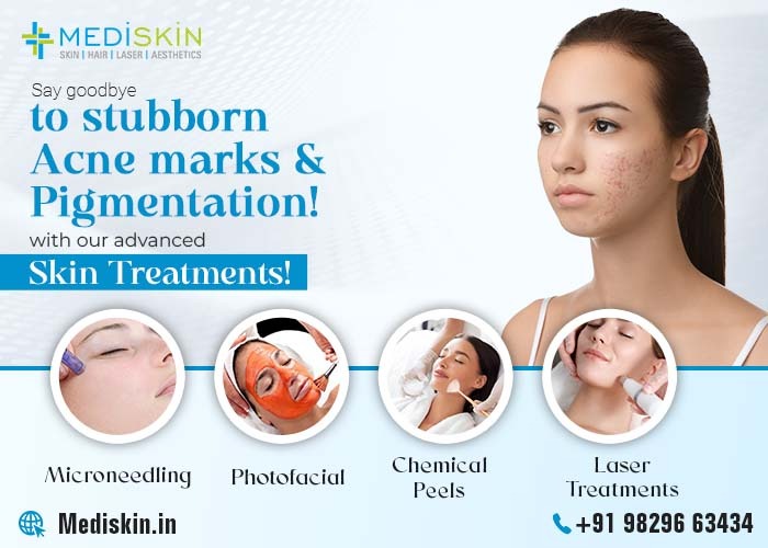 Say Goodbye to Stubborn Acne Marks & Pigmentation with MEDISKIN’s Advanced Skin Treatments